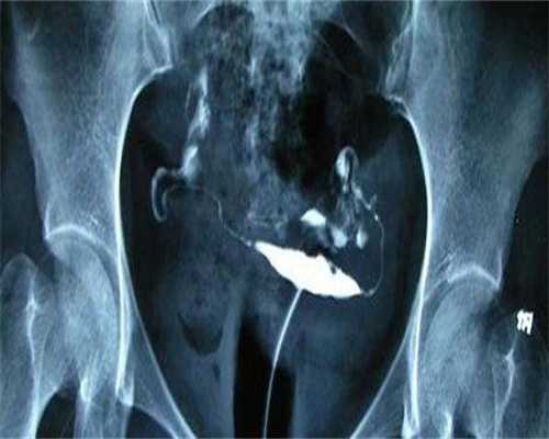 代孕套餐优惠：全球第一个试管婴儿